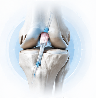 ACL Reconstruction