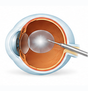Ophthalmology Care