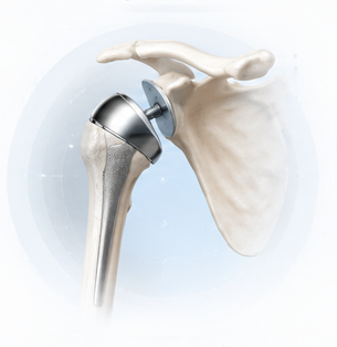 Shoulder Replacement