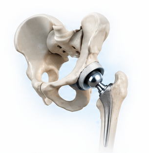 Total Hip Replacement