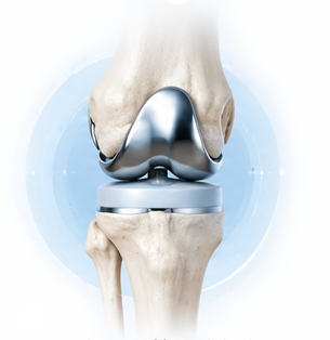 Total Knee Replacement